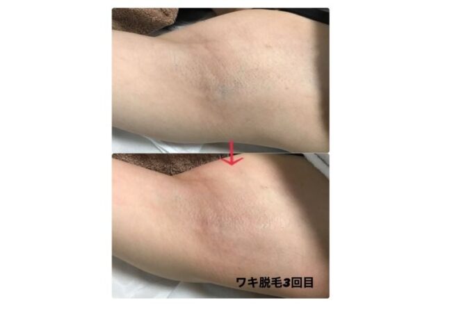 ワキ脱毛の効果はある メリットと効果が実感できる回数 料金や注意点