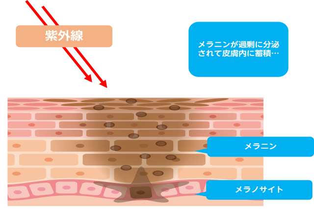 脇に黒ずみができる原因は 脇のブツブツの対策や予防方法を紹介 ユア脱毛