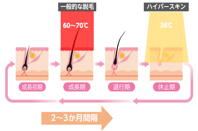 脱毛サロンはいつ効果が出る 効果が実感できる回数と毛が抜ける仕組みを徹底解説